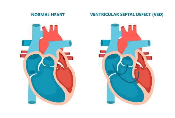 Defecto septal ventricular CIV. Enfermedades musculares del corazón humano de sección transversal. Concepto de cardiología. — Vector de stock