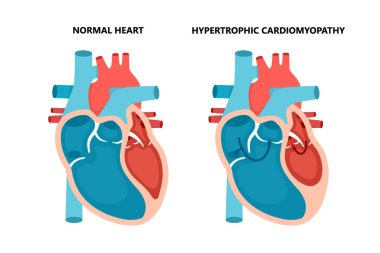Hypertrophic cardiomyopathy with cross-section view. Human heart muscle diseases. Cardiology concept. clipart
