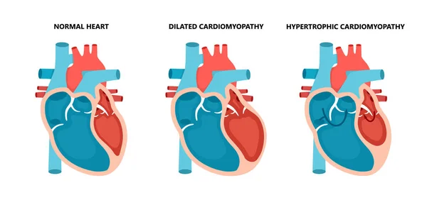 Types of heart diseases - normal, hypertrophic and dilated cardiomyopathy. Human heart muscle diseases cross-section. — Wektor stockowy