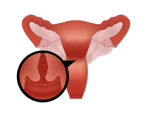 Ilustração realista do sistema reprodutivo humano feminino em fundo branco foco no colo do útero —  Vetores de Stock