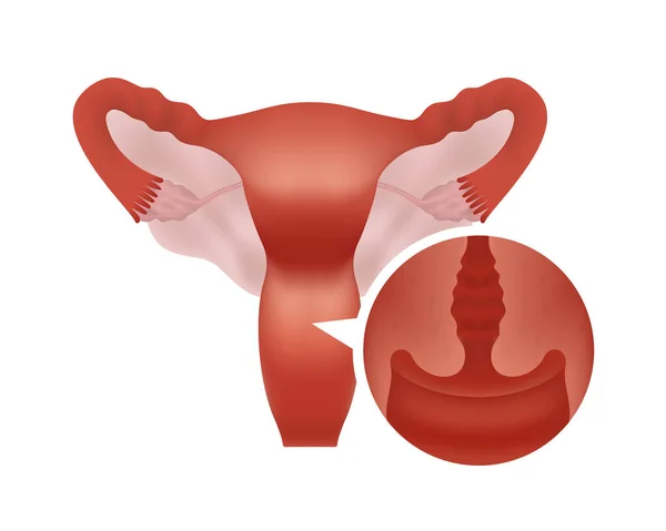 Sistema riproduttivo realistico con sezione ravvicinata. Sistema riproduttivo umano femminile con particolare attenzione alla cervice. — Vettoriale Stock