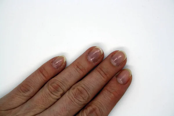 Vrouwelijke Hand Met Gebeten Nagels Een Witte Achtergrond — Stockfoto