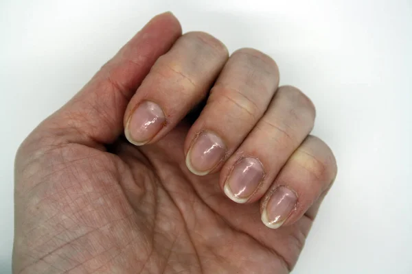 Female Hand Bitten Nails White Background — Stock Photo, Image