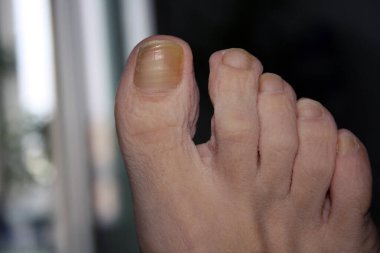 Vitamin eksikliği. Yaralı ayak tırnakları. Metin için boşluk.