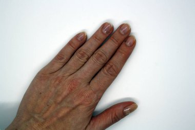 Beyaz arka planda tırnakları yenmiş bir kadın el..