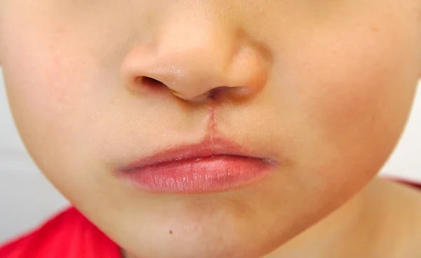 Chlapce ukazuje jednostranné rozsedliny lip opraveno. — Stock fotografie