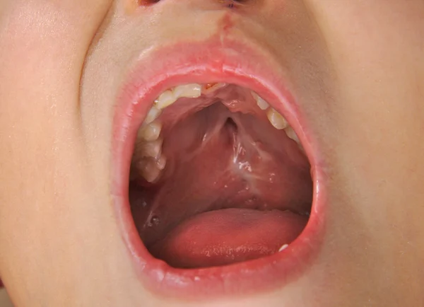 Menino mostrando uma úvula em uma fenda labiopalatina reparada . — Fotografia de Stock