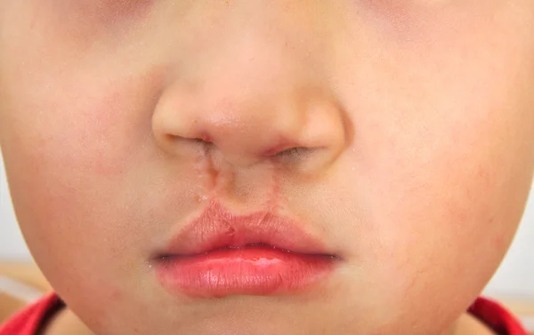 Boy showing bilateral cleft lip repaired. — Stock Photo, Image