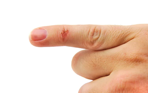 Wound on baby or pinky finger isolated on a white background — Stock Photo, Image