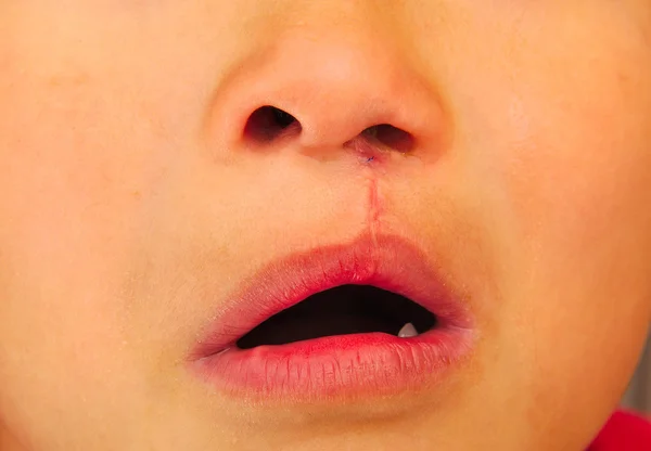 Junge, der eine einseitige Lippenspalte zeigt, repariert. — Stockfoto