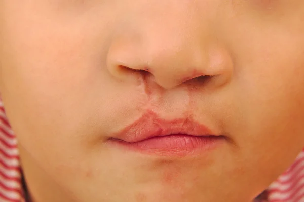 Jongen tonen een bilaterale gespleten lip gerepareerd. Stockafbeelding