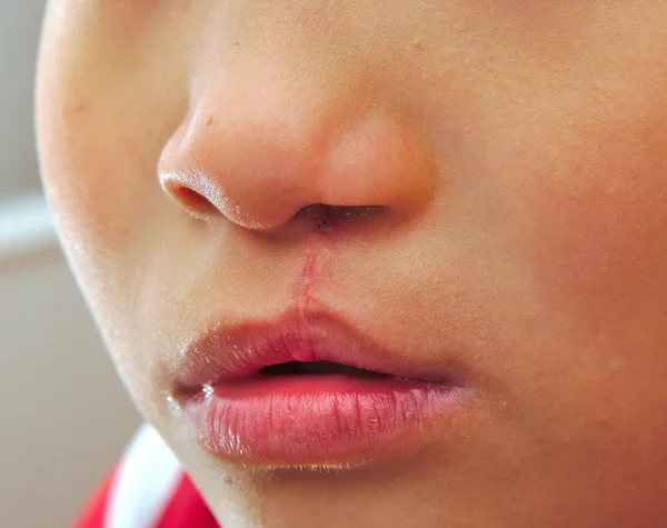 Junge zeigt eine monolaterale Lippenspalte repariert. — Stockfoto