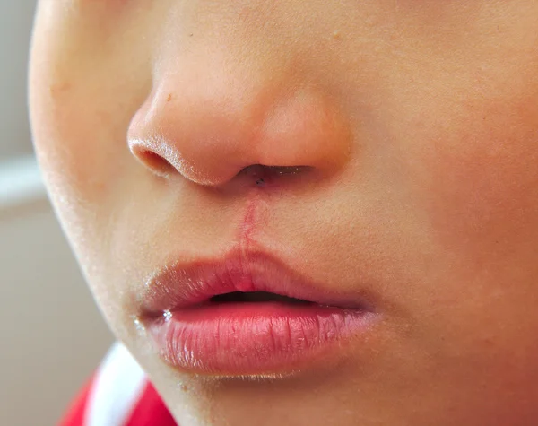 Menino mostrando uma fenda labial monolateral reparada . — Fotografia de Stock