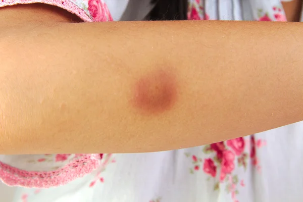 Hematoma ou hematoma no braço da menina ferida — Fotografia de Stock