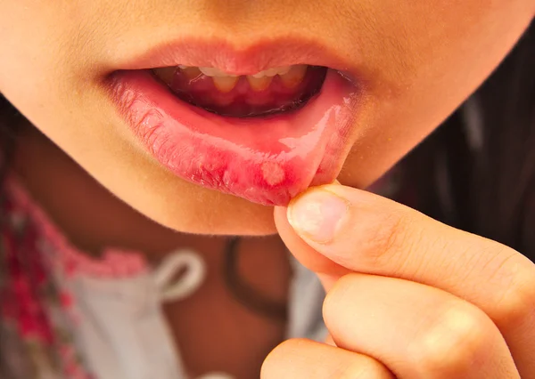 Girl with aphthous stomatitis in her lip — Stock Photo, Image