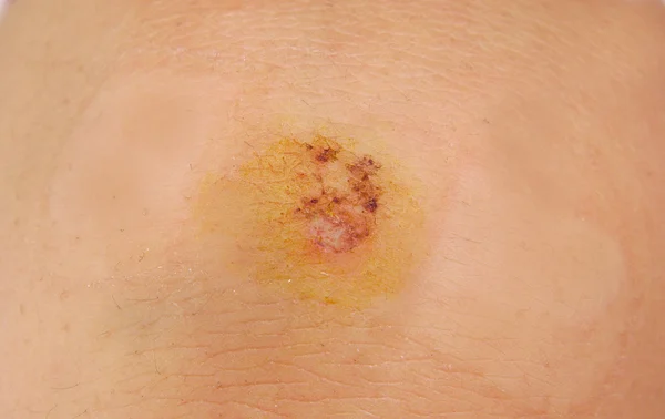 Closeup της μια πληγή ή διάλυση γόνατο — Φωτογραφία Αρχείου