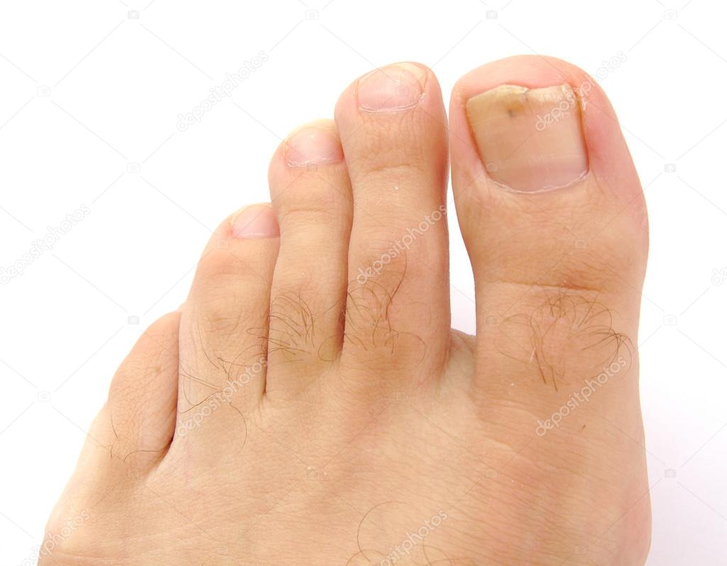 Male foot and toes with damaged nail isolated on a white background