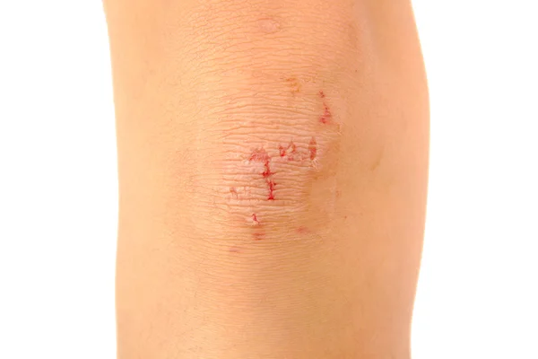Vrouw verpleging een gewonde knie geïsoleerd op een witte achtergrond. Medische concept Stockafbeelding