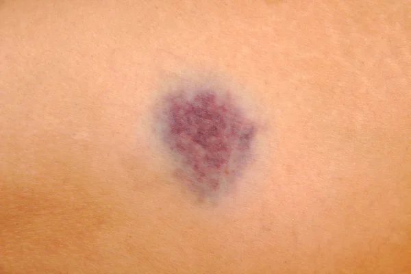 Close up of bruise on wounded woman leg skin. Gender violence concept. Royalty Free Stock Images