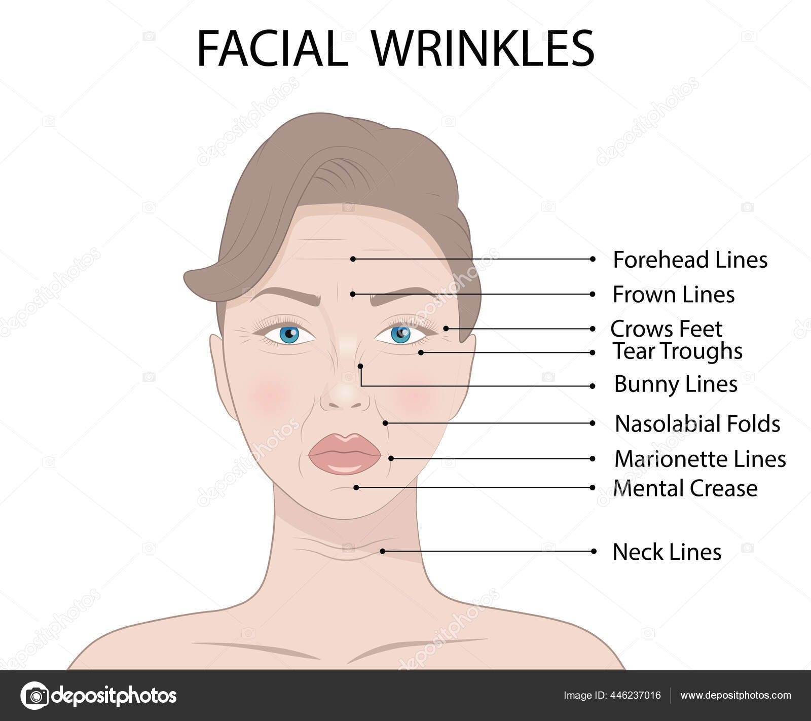 Vector Illustration Common Types Facial Wrinkles Cosmetic Surgery Woman