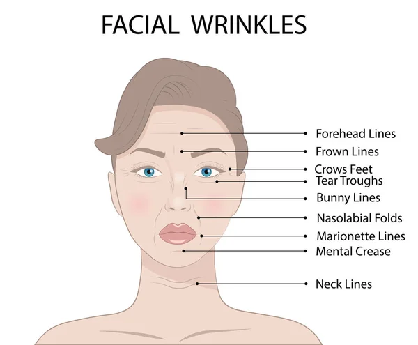 Vector Illustration Common Types Facial Wrinkles Massive Surgery Woman Face — 스톡 벡터