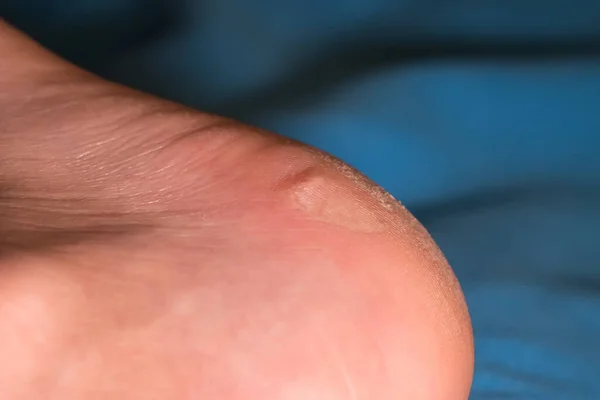 The outer side of the heel with a burst callus and dry skin. Close-up. Blue background