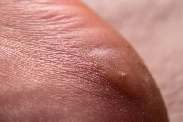 The outer side of the male heel with a callus and dry skin. Close-up