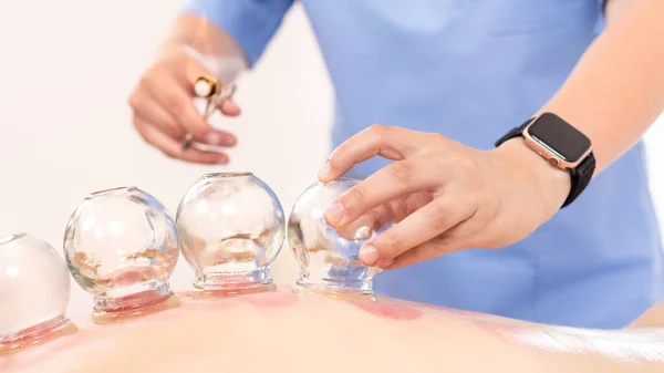 Cupping Therapy Mladá Fyzioterapeutka Aplikující Skleněné Sací Banky Zadní Stranu — Stock fotografie