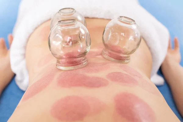 Vakuové Cupping Therapy Pozadí Léčba Používaná Tradiční Čínské Medicíně Pro — Stock fotografie