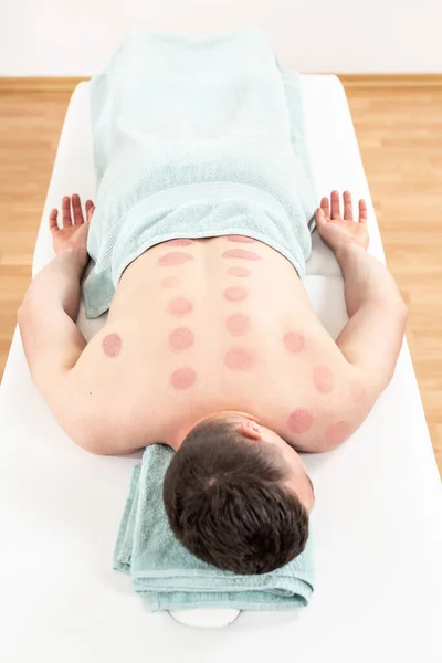 Young man relaxing after vacuum cupping therapy. High angle view of a back with skin bruising after cupping therapy.