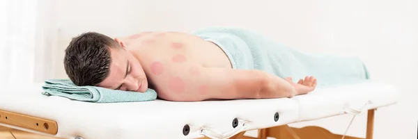 Young Man Relaxing Vacuum Cupping Therapy Back Skin Bruising Cupping — Stock Fotó