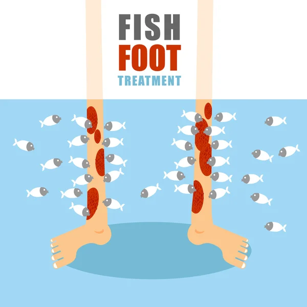 Лікування риб ніг. Медична процедура лікування псоріазу — стоковий вектор