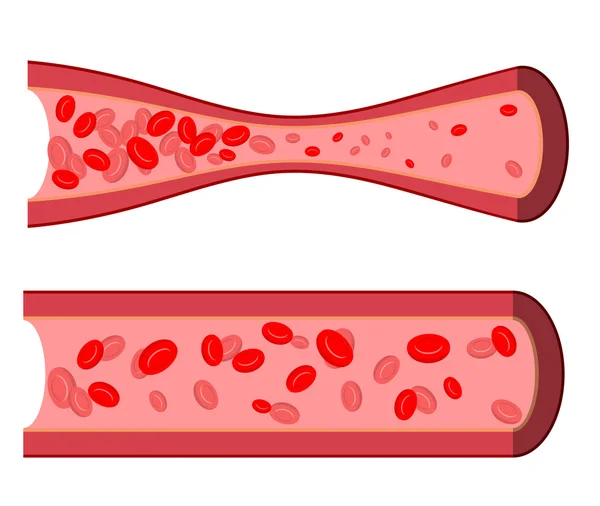 Bloody artery. Blockage of blood vessels. Sick artery with leuk — Stock Vector