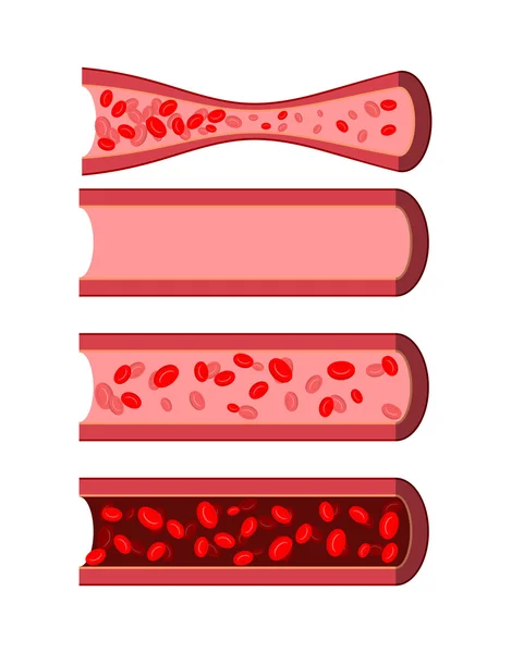 Anatomical human blood vessels set. Healthy blood vessel. Diseas — Stock vektor