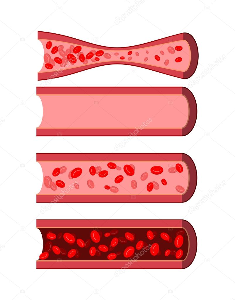 Anatomical human blood vessels set. Healthy blood vessel. Diseas