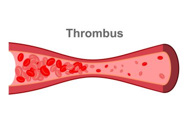 Blood clot in  blood vessel. Diseases of Veins in human body. An clipart