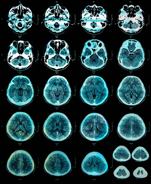 Beynin manyetik rezonans renk görüntüsü (MRI).