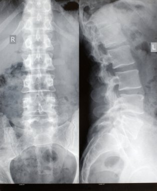 Omurilik xray