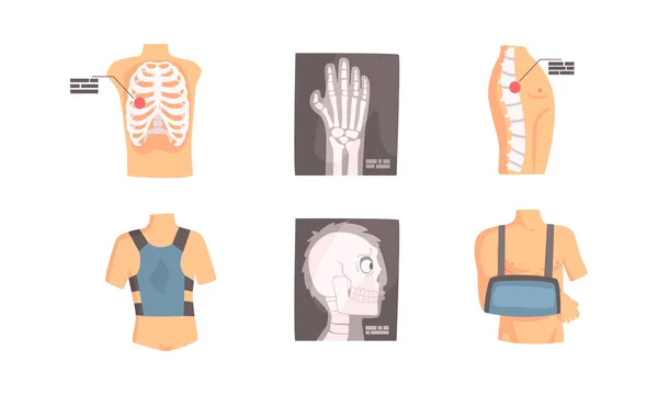Conjunto de fraturas ósseas, exame médico e tratamento de lesões nas costas e na coluna ilustração do vetor dos desenhos animados — Vetor de Stock