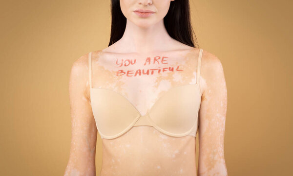 You are beautiful motivational inscription on chest of woman with vitiligo disorder