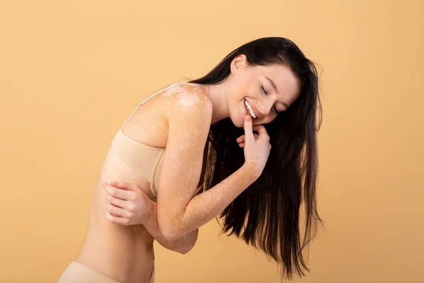 Aceitação do Corpo. Retrato de senhora bonita feliz com vitiligo pele vestindo roupa interior — Fotografia de Stock