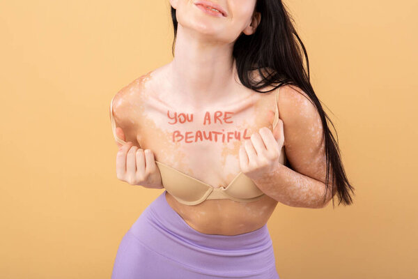 You Are Beautiful Inscription Written On Females Chest With Vitiligo Skin