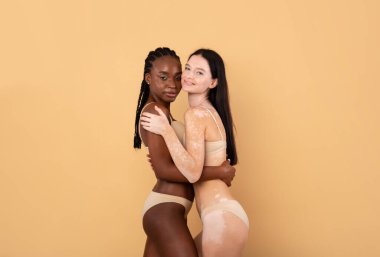 Güzel siyah bayan ve çekici kadın Vitiligo tenli birlikte poz veriyorlar.