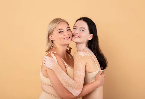 Happy Plus Size Woman And Lady With Vitiligo Skin Embracing Together — Stock Photo, Image