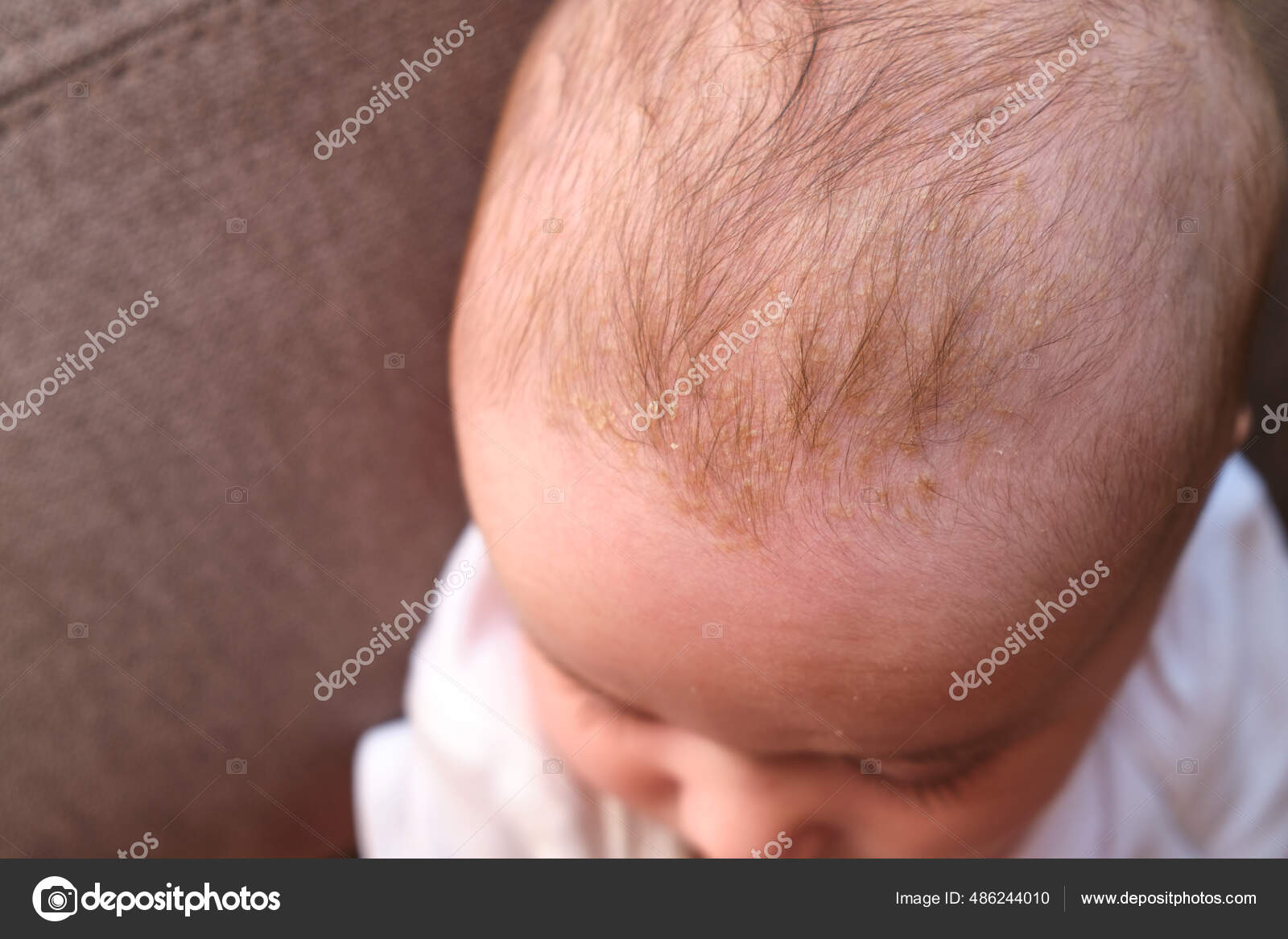 Cradle Cap Seborrheic Dermatitis Head Babies Stock Photo by