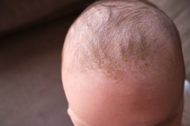 Bebeklerin kafasında beşik kapağı (seborrheic dermatitis)