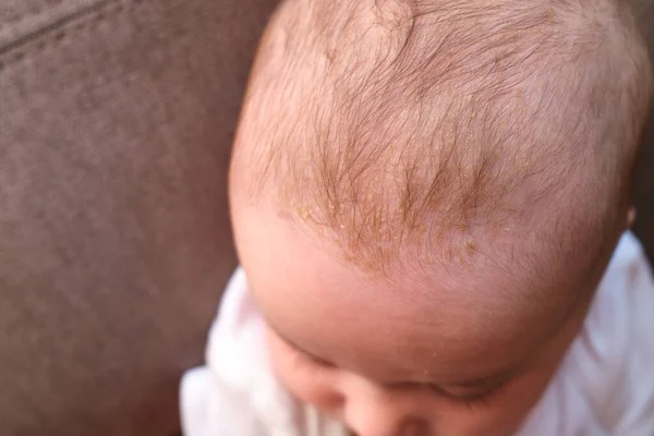 Cradle Cap Seborrheic Dermatitis Head Babies — Stock Photo, Image