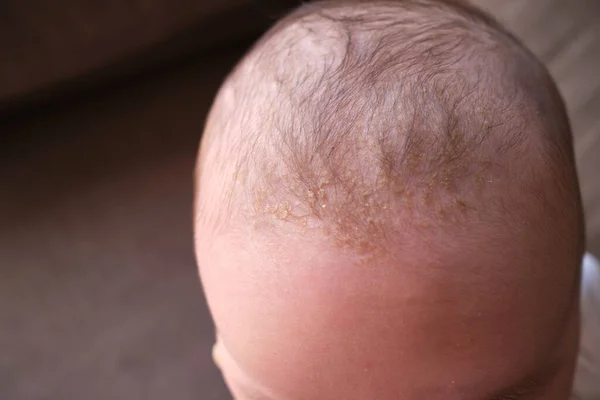 Bebeklerin Kafasında Beşik Kapağı Seborrheic Dermatitis — Stok fotoğraf