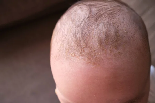 Bebeklerin kafasında beşik kapağı (seborrheic dermatitis)
