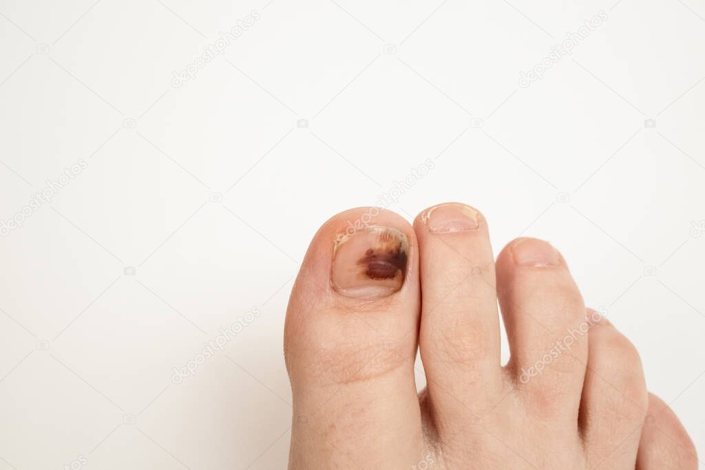 Bruising under the fingernail of the big toe